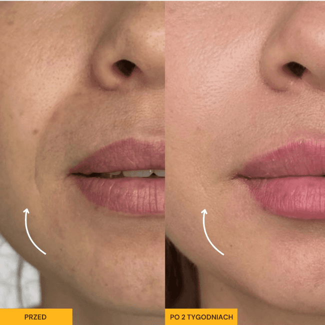 ProDrain - Twój sposób na natychmiastowy lifting