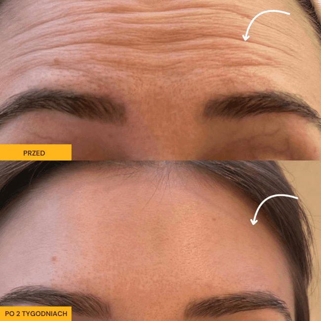 ProDrain - Twój sposób na natychmiastowy lifting