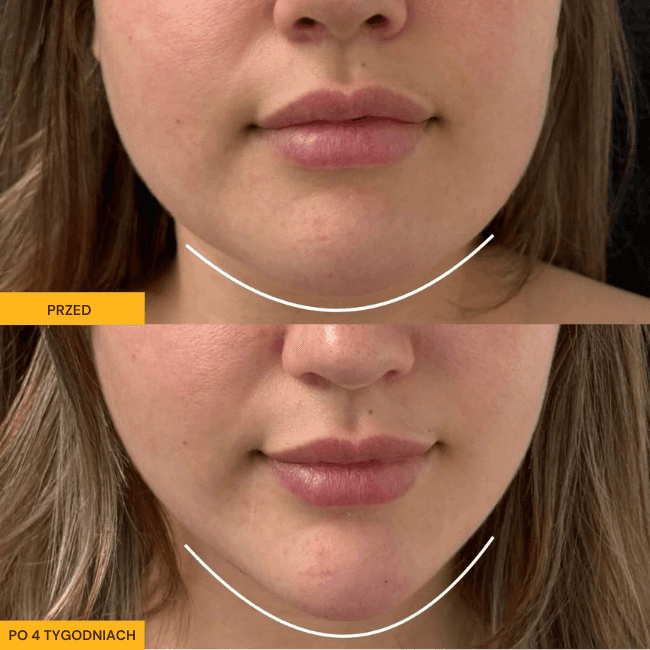 ProDrain - Twój sposób na natychmiastowy lifting